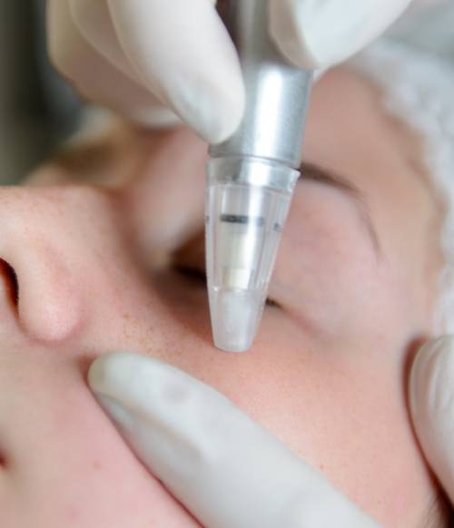 Microdermabrasion Facial Melbourne