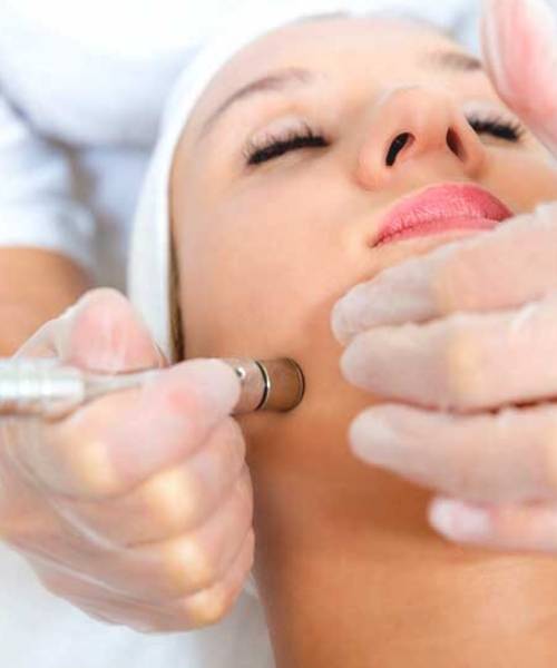 Microdermabrasion treatment